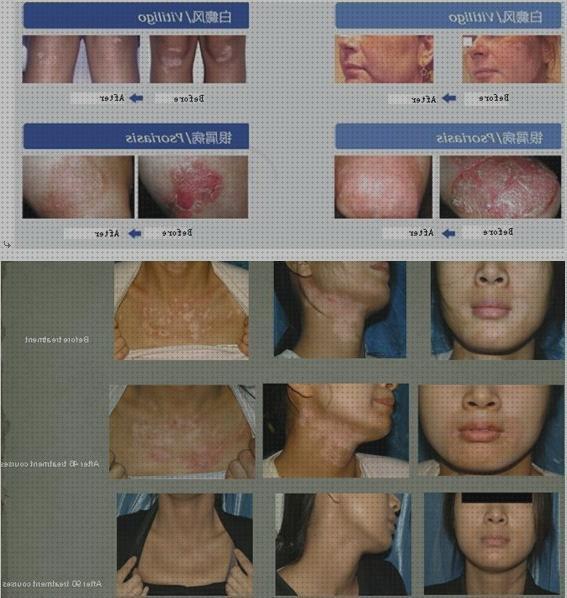 ¿Dónde poder comprar lampara uvb lampara fototerapia uvb 311nm vitiligo?